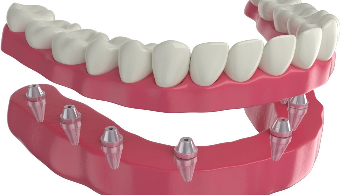 PRUEBA LIBRE - TECNICO SUPERIOR EN PROTESIS DENTALES